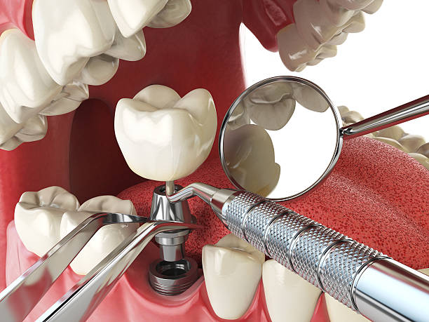 Best Emergency Tooth Extraction in Fort Recovery, OH